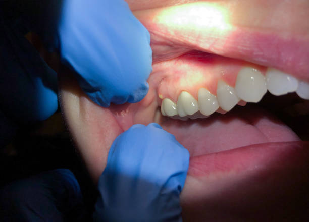 Best Tooth Infection Emergency Dentist  in Hallam, PA